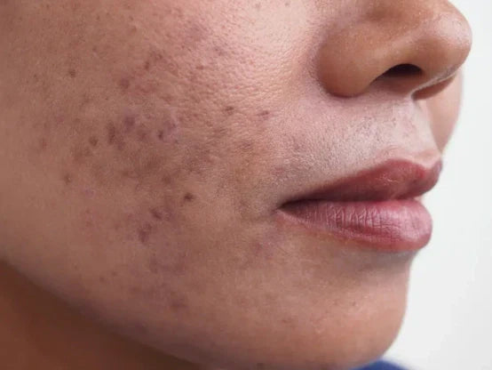 6 consejos imprescindibles para eliminar manchas de la cara